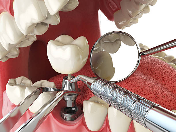 Best Emergency Dentist for Lost Fillings or Crowns in Philomath, OR
